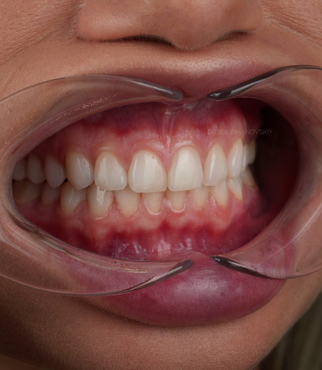 صورة تشخيصية للوضع الأولي باستخدام المبعدات
