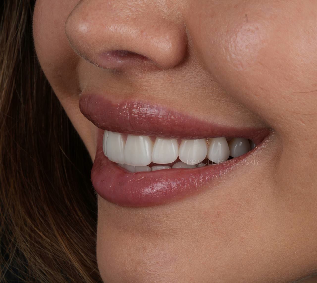 A three-quarter view of a smile after ceramic veneer work