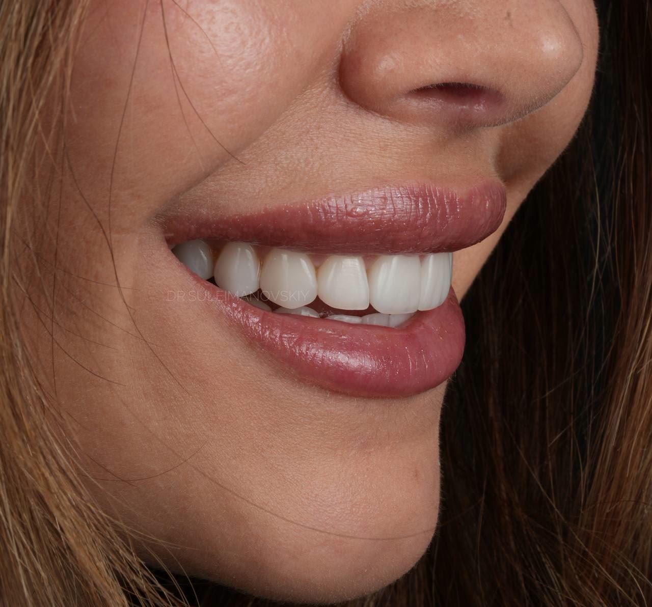 A profile view of a smile after ceramic veneer work