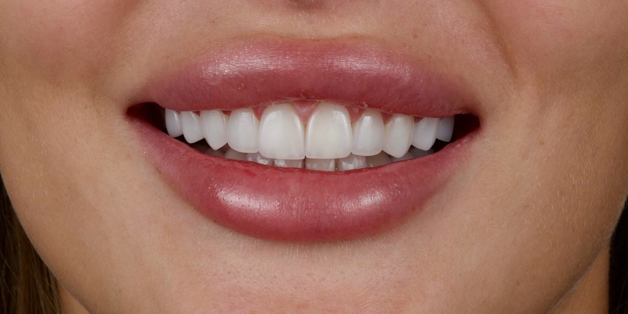 A smile after ceramic veneer work