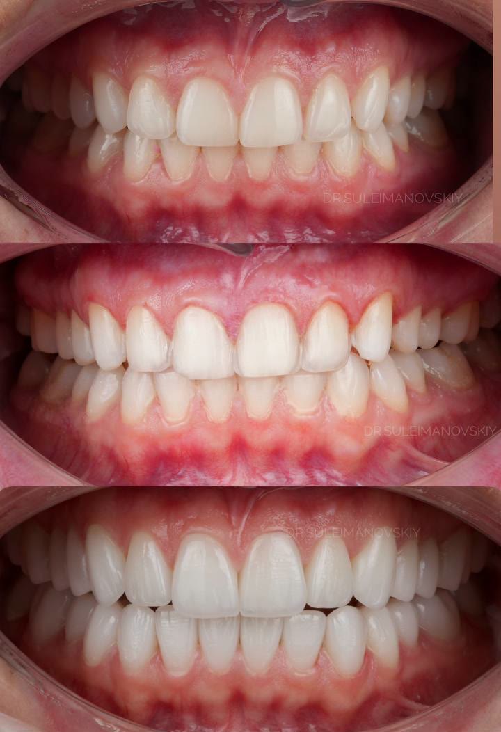 Three clinical photographs of one case taken at different stages